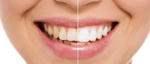 Blanqueamiento dental
