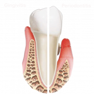 gingivitis periodontitis leyenda