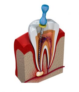 Endodoncia